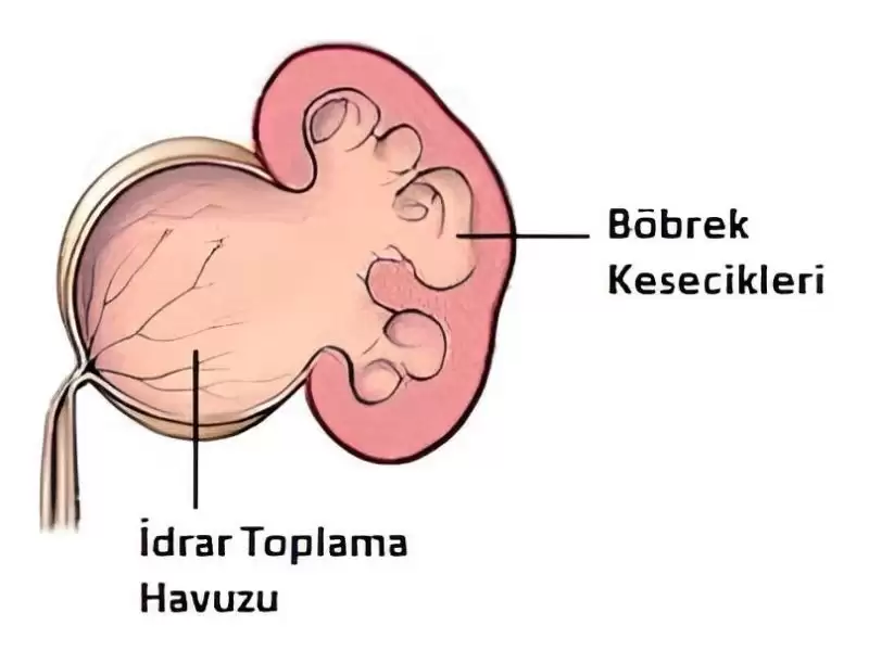 idrar-kanallarinda-genisleme-hidronefroz